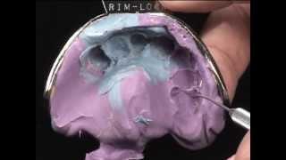 Rapid Anesthesia  , Reverse Preparation & Two Cord Impression Techniques