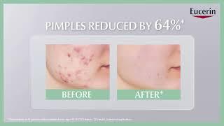 Reduce acne in 7 days with ProACNE Solution A.I. Clearing Treatment