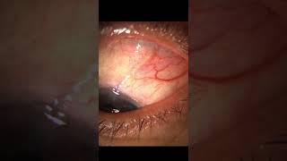 Glaucoma Surgery:  Ahmed Valve