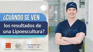 ¿Cuándo se notan los cambios de una Lipoescultura? I Resultados de una Lipoescultura I Liposucción