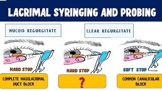 Lacrimal Syringing and Probing : Technique and Interpretation of results