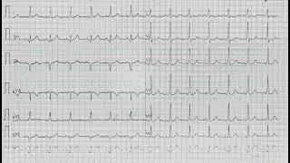 ECG Quiz 20 @LearningCardiology