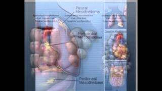 mesothelioma survival rate