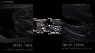 Fetal Gender Determination Ultrasound | 19-32 Weeks Male & Female | Baby Boy/Girl Sex USG #shorts