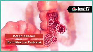 Kolon Kanseri Belirtisi ve Tedavisi | Kolon Kanseri | Kolon Kanseri Evreleri | Dr. Çetin Karaca