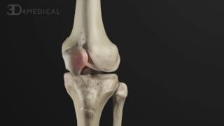 Anterior Cruciate Ligament: Pathology and Management | Animated Tutorial