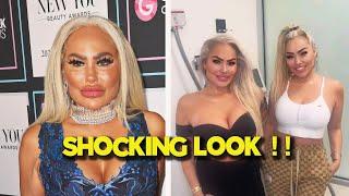 Darcey Silva Shocks Fans With Botched Face Following New Plastic Surgery