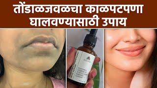 तोंडाजवळकलचा काळपटपणा कसा घालवायचा? How To Get Rid Of Blackness Near The Mouth | Skincare | MA2