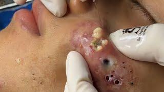 Big Cystic Acne Blackheads Extraction Blackheads & Milia, Whiteheads Removal Pimple Popping # 9175