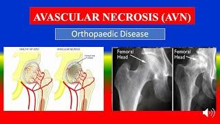 AVASCULAR NECROSIS (AVN) - Definition, types, causes, pathophysiology, signs & symptoms, medicine