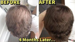 He Was Microneedling WITHOUT Finasteride/Minoxidil For 4 Months..SHOCKING Results!