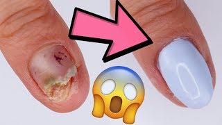 DAMAGED NAIL...