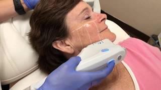 Ultherapy Treatment | Beleza MedSpa | Austin TX