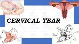 How to Repair Cervical Tear or Cervical Laceration? | TOACS & OSCE Station