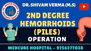 2ND DEGREE HEMORRHOIDS KSHAR KARMA BY - DR. SHIVAM VERMA (M.S) - 9756577038 , 8791590248