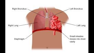 Diaphragmatic Hernia