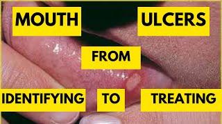 Mastering Recurrent Aphthous Stomatitis -Most Common Mouth Ulcers and Effective Treatment Strategies