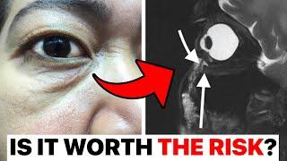 Why I Stopped Filling Tear Troughs... | Surgeon Reacts