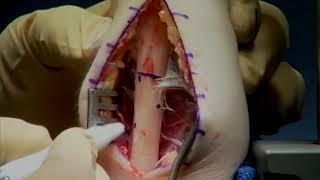 Step Cut Ulnar Shortening Osteotomy for Ulnar Impaction Syndrome