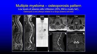 Multiparametric imaging of bone marrow metastatic disease, Anwar Padhani