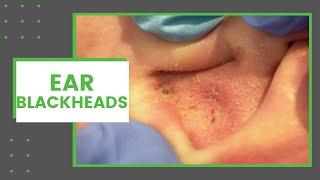 Ear Blackheads | Dr. Derm