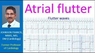 Atrial flutter