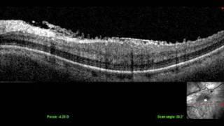 Spectral Domain OCT Raster Scan