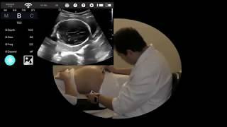 YOUKEY wireless ultrasound Scanner  Obstetric application