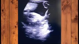 24 weeks baby scan | Baby Brain, Face, Neck & Heartbeat | Baby genderreveal usg | Posterior Placenta