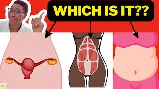 Causes Of Big Stomach In A Woman - Fibroids | Diastasis Recti | Belly Fat?