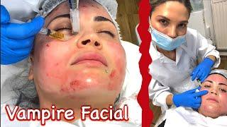 Vampire Facial (PRP)- combining Microneedling and Injection Technique