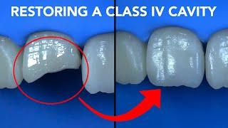 Class IV Restoration with G-aenial A'CHORD