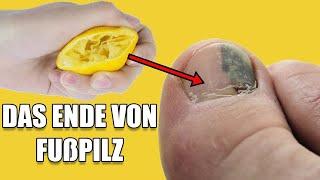 Dieses Hausmittel entfernt lästigen Fuß- und Nagelpilz