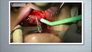 Zygomatic Implant Video II - Noris Medical