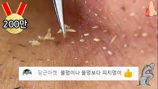 tweezer (피지제거) 멍 때리고 보게 되는 피지제거 영상 피지멍!