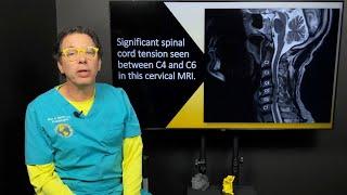 Internal tremors, whole body vibrations, & the connection to neck instability & spinal cord tension