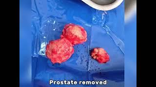 prostate removal(masane ke Rasoli)