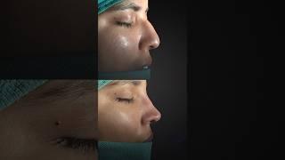 RHINOPLASTY  Dr.Daria Hamrah