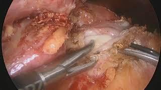 위밴드제거수술과 동시에 시행한 위소매절제술.1-stage sleeve gastrectomy due to chronic band slippage
