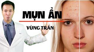 Mụn ẩn ở Trán - Sai lầm nào khiến Skinacare dù nỗ lực cũng KHÔNG cải thiện| Dr Hiếu