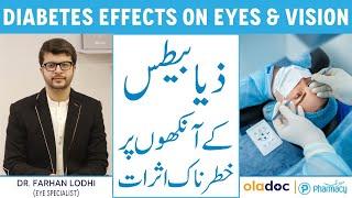 Diabetic Retinopathy Treatment - Aankhon Per Sugar Ke Asraat - Diabetes Effects on Eyes & Vision