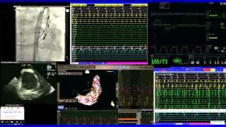 Ablation of Atrial Fibrillation with Complex Anatomy - kchrs2011