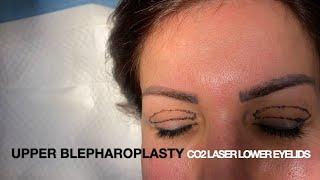 UPPER EYELID SURGERY WITH CO2 LASER LOWER EYELIDS - Watch video with Dr. Philip Solomon