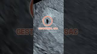 Your baby at 4 weeks pregnant - Early Ultrasound Scan