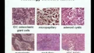 Molecular Profiling Diagnostics for Breast Cancer