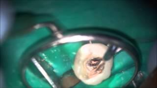 squirt or rapid flow obturation technique of root canals