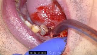 tooth extraction