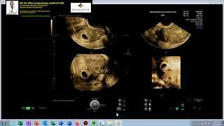 Cornual Pregnancy 6-7 weeks (Dr Wiku Andonotopo)