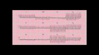 Reading the 12-lead ECG/EKG - six quick steps