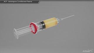 ACP - Autologous Conditioned Plasma